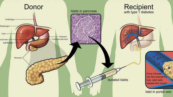 Ученые успешно пересадили донорские островковые клетки в сальник брюшной полости: они начали воспроизводить инсулин